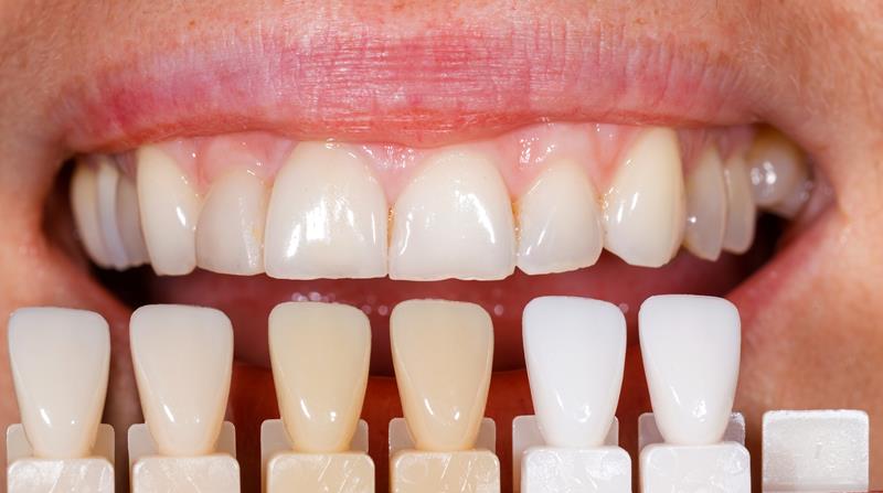 Veneers Livingston, TX