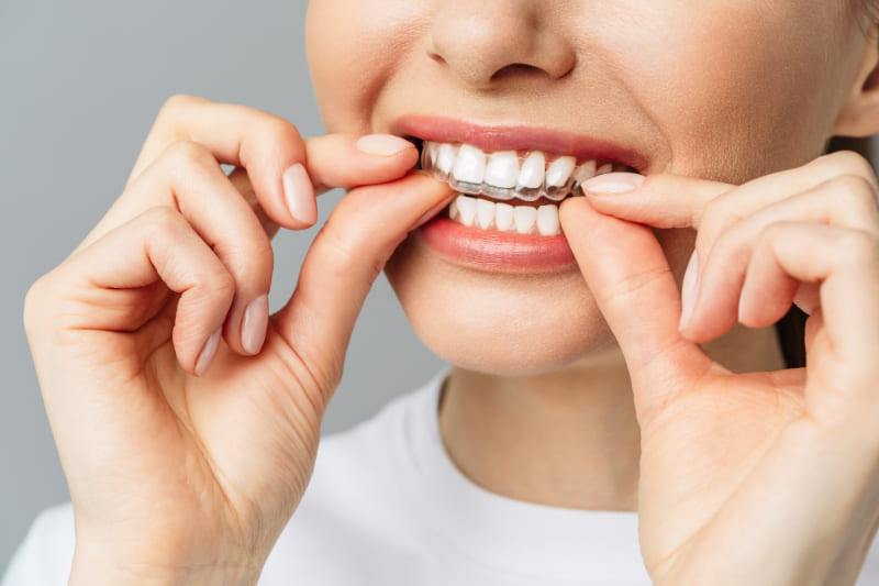 Invisalign Livingston, TX